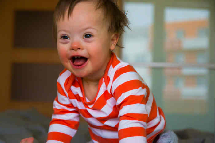 Sindrome Di Down Cos La Trisomia 21