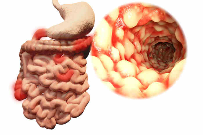Morbo di Crohn: Cos'è, i sintomi, la diagnosi e la cura
