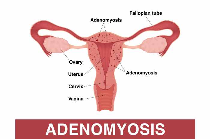 Adenomiosi uterina
