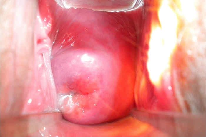 Tumore cervice uterina: dallo screening alla diagnosi