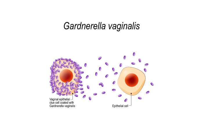 Infezione da gardnerella vaginalis