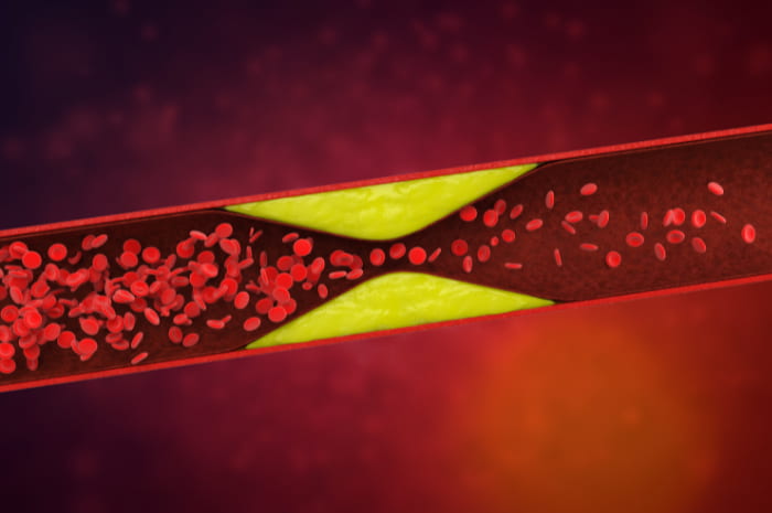 Ipercolesterolemia familiare omozigote