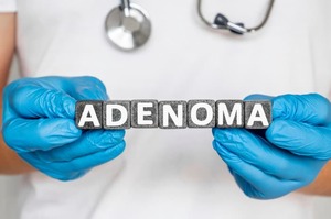 Adenoma, il tumore dei tessuti epiteliali ghiandolari