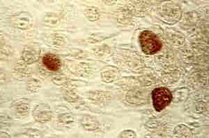 Clamidia, l'infezione da batterio Chlamydia Trachomatis