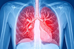 Embolia polmonare acuta: cosa cambia con le nuove Linee Guida AHA/ACC 2026 