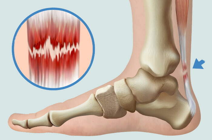 Tendinosi achillea, lesione del tendine di Achille