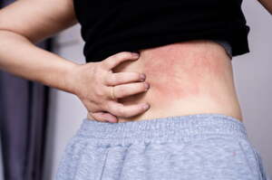 Patologie cutanee da caldo e sudore