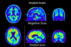 Nuove frontiere terapeutiche per l'Alzheimer: i farmaci anti-amiloide