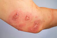 Bari, sospetta scabbia al Policlinico: 22 sanitari al Pronto soccorso