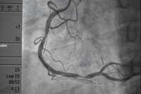 Sindromi coronariche acute: linee guida ACC/AHA 2025 