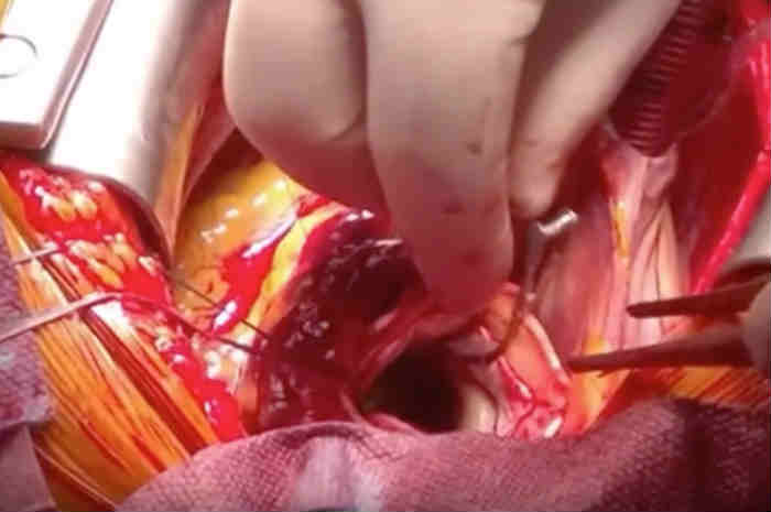 ricostruzione radice aortica