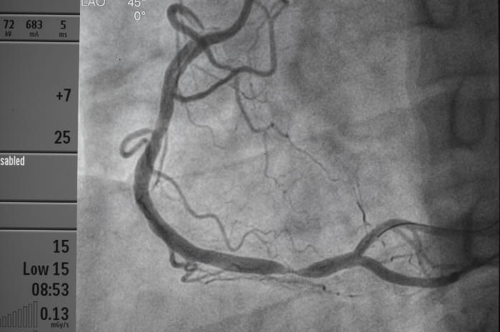 Sindromi coronariche acute: linee guida ACC/AHA 2025 