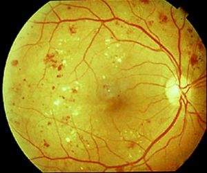 retinopatia-ploriferante2