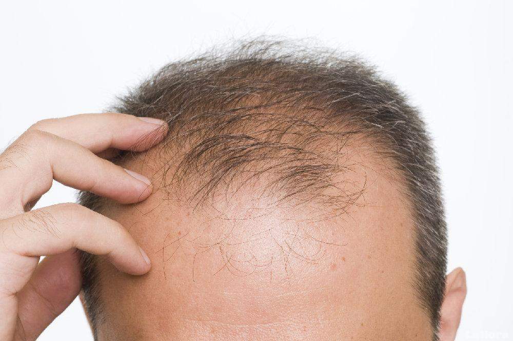 Alopecia, come curare la caduta dei capelli